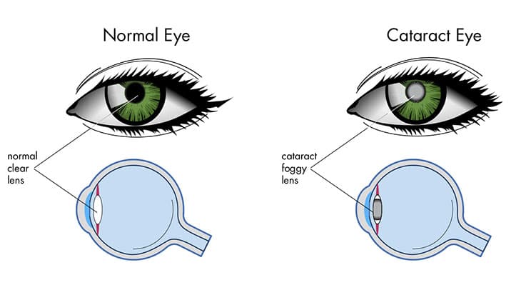 Normal eye vs. cataract eye, normal clear lens vs. cataract foggy lens.
